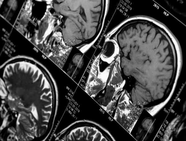 X-ray of brain